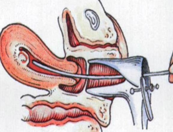 刮宮要休息幾天 15—30天及時(shí)監(jiān)測避免勞動(dòng)受寒