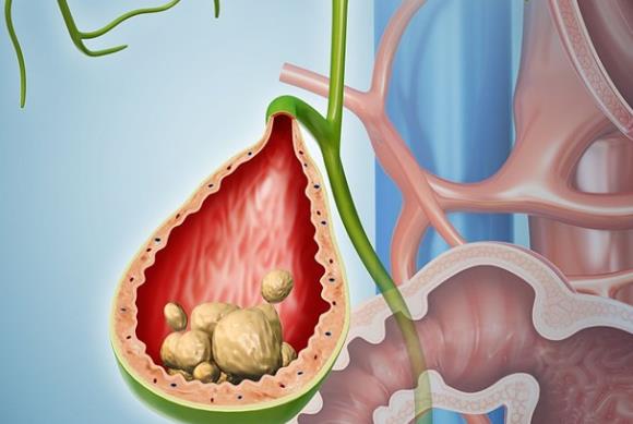 膽結石怎么形成的 膽汁成分失調淤積膽囊病變