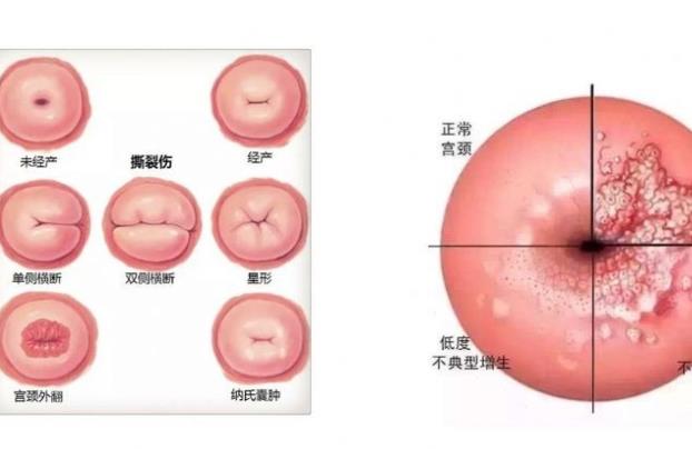 慢性宮頸炎能自愈嗎 復發(fā)性強及時清潔就診