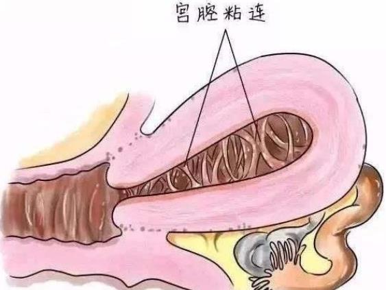 刮宮術后做完要注意哪些 監(jiān)測出血量注意飲食生活習慣