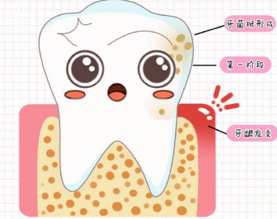 牙周炎治療費用大概多少 600/次療程三次局部刺激