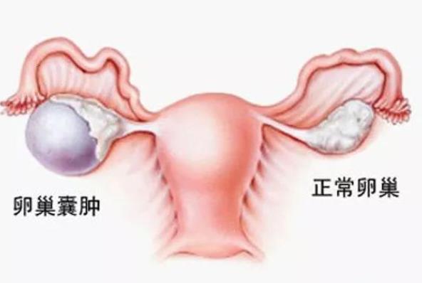 巧克力囊腫能懷上孩子嗎 不孕率高達(dá)50％及時治療