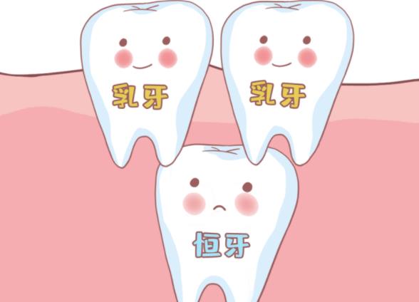 兒童換牙長歪了怎么辦 5-12歲及時矯正對癥治療