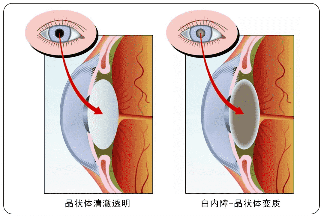 重慶高溫天氣下，普瑞眼科內(nèi)購會護眼福利來襲