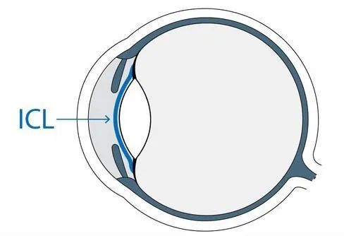 劉保松博士談ICL晶體植入?：同樣是近視手術，ICL為什么那么貴？