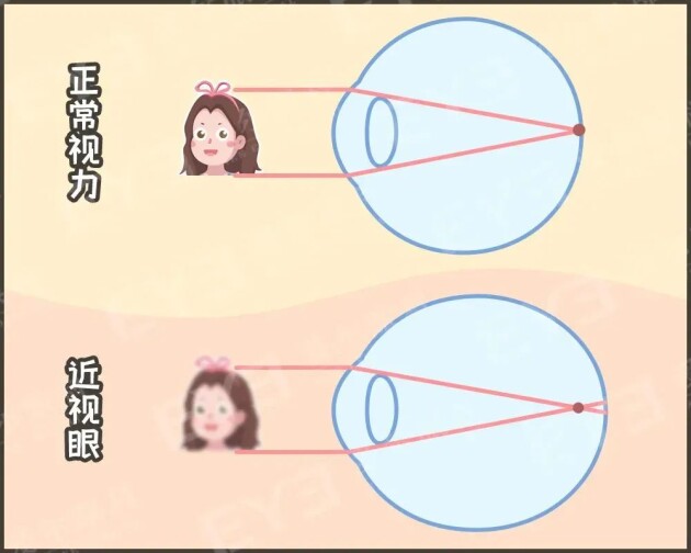 孩子戴上眼鏡度數(shù)會越來越高，確實如此嗎？——合肥愛爾眼科