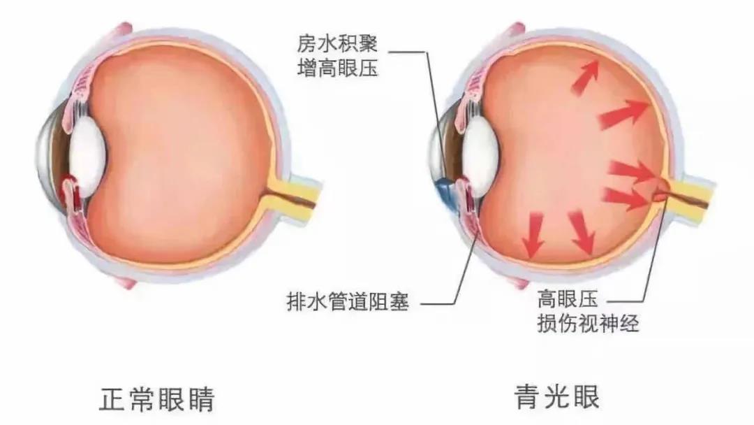 慎防青光眼 合肥愛爾眼科專家科普