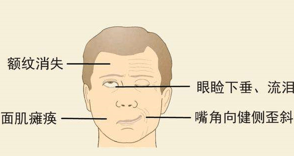 北京廣濟醫(yī)院怎么樣，治療面癱找對科室少走彎路