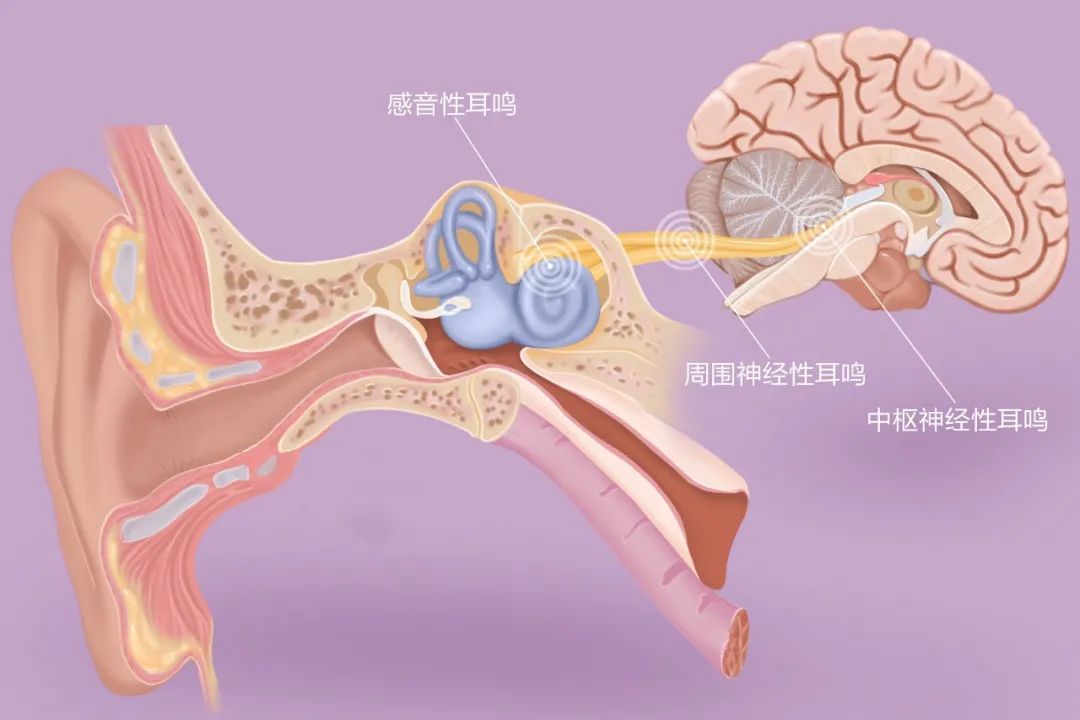 “嚶嚶嚶…”，成都民生耳鼻喉醫(yī)院提醒：耳鳴是身體的警報，須重視！