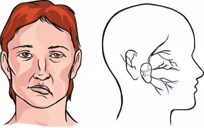 上海健橋醫(yī)院好不好，面癱的兩種常見癥狀和治療方法