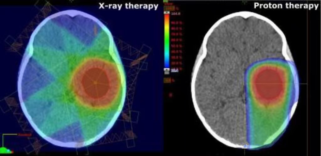 直播科普|質子治療為什么是兒童腫瘤放療的“金標準”