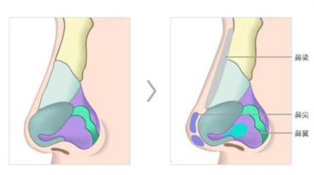 隆鼻取出假體后鼻子會(huì)變形嗎 什么情況下需要取出假體
