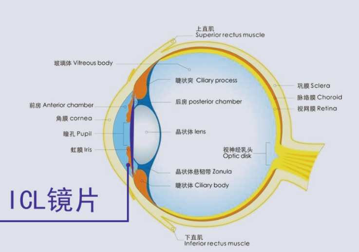  ICL晶體植入術(shù)貴在哪里？合肥普瑞眼科專家來(lái)解答（近視手術(shù)鉅惠來(lái)襲）