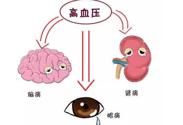 高血壓有哪幾種類型？高血壓要做些什么檢查項目？