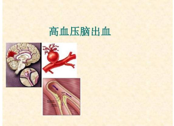 高血壓為什么會(huì)引起腦出血？高血脂會(huì)引起高血壓嗎？