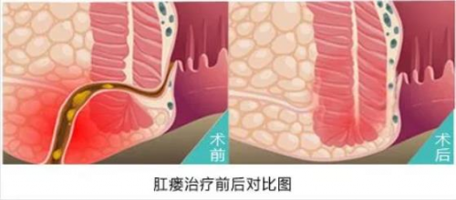 廣州東大肛腸醫(yī)院可信嗎肛瘺術后要想恢復快，這5點很重要