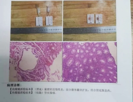 廣州東大肛腸醫(yī)院好不好34歲女士腸息肉切除后3年不查，拖出腸癌