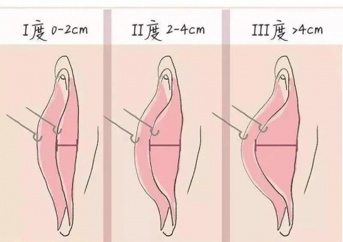 陰唇肥大又看不見，手術還有必要做嗎？在昆明這里告訴你!