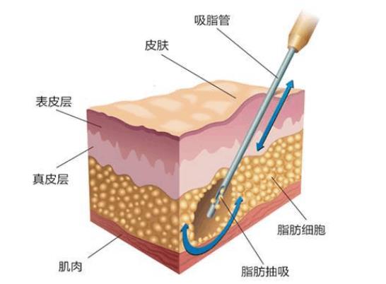 吸脂肪對(duì)身體有害嗎 吸脂肪手術(shù)需要多少錢(qián)