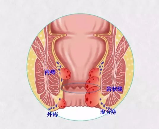 痔瘡之痛何以解，揚州妙手肛腸醫(yī)院為痔瘡病友解決“難言之苦”