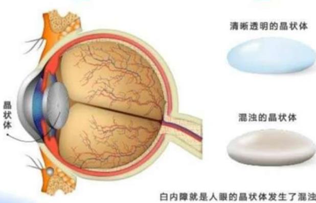 白內(nèi)障做手術(shù)有效嗎 白內(nèi)障手術(shù)有哪些風(fēng)險(xiǎn)