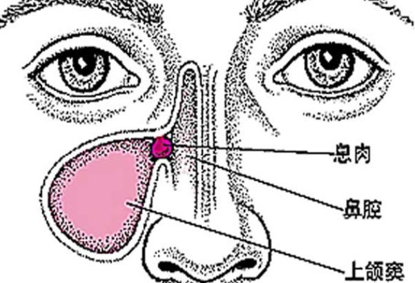 引起鼻息肉的原因有哪些 慢性感染感冒鼻塞飲食個(gè)人衛(wèi)生等
