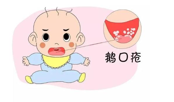 鵝口瘡是怎么引起的？寶寶得鵝口瘡怎么護(hù)理？