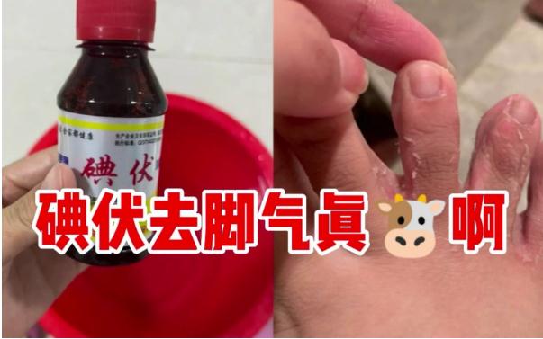 碘伏能治療腳氣嗎？腳氣是缺乏維生素嗎？