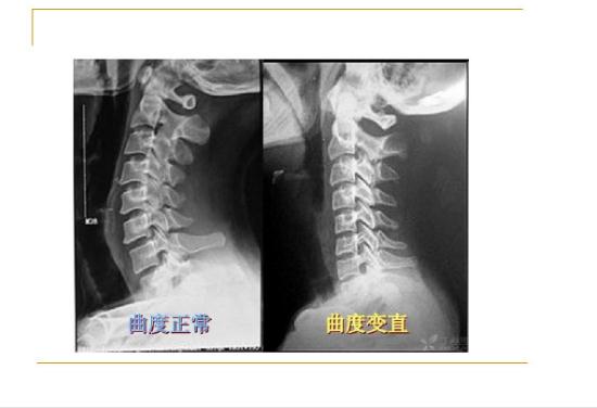 頸椎病能引起后背疼嗎？頸椎病的鑒別診斷有哪些？