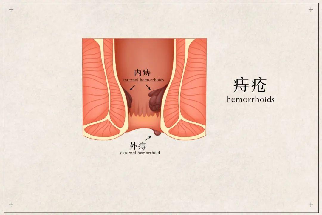 包頭東大肛腸?？漆t(yī)院詳解便血是怎么回事？