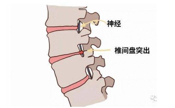 腰間盤突出吃什么藥？腰間盤突出能治愈嗎？