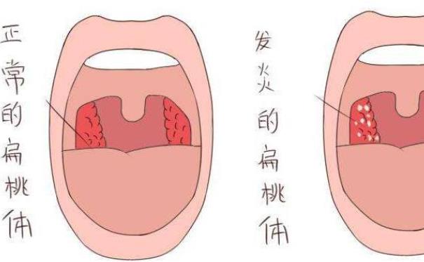 什么是扁桃體腫大 扁桃體腫大的病因是什么