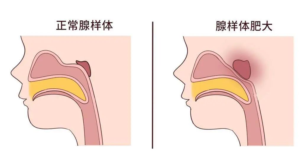 為什么現(xiàn)在患腺樣體肥大的孩子越來越多？聽聽成都民生耳鼻喉醫(yī)院怎么說