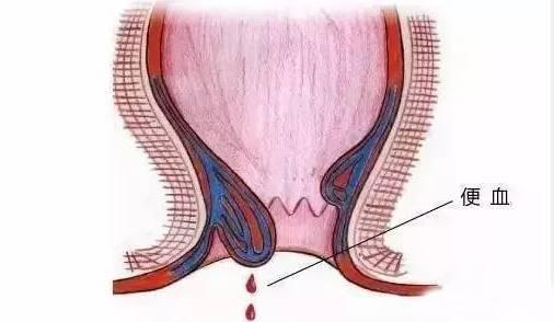 保定東大肛腸醫(yī)院丨肛腸疾病千萬別硬抗，這六種癥狀一定要去醫(yī)院！