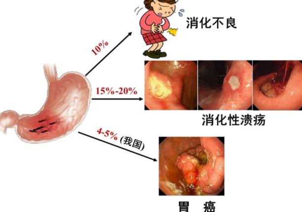 丁香茶能殺死幽門(mén)螺桿菌嗎 喝酒能殺死幽門(mén)螺桿菌嗎