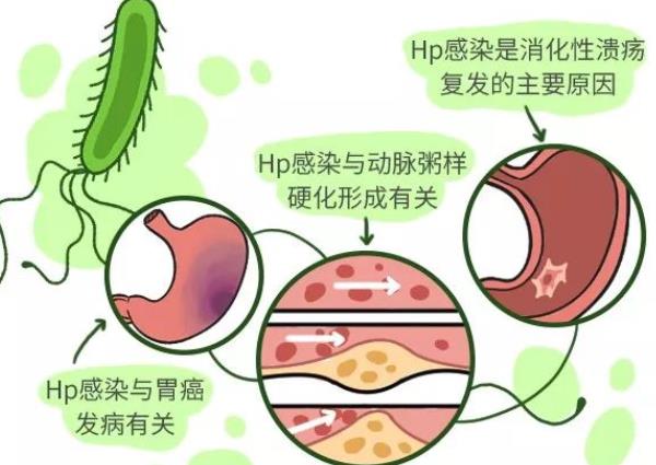 幽門螺桿菌會(huì)傳染給小孩嗎 幽門螺桿菌如何傳染給小孩