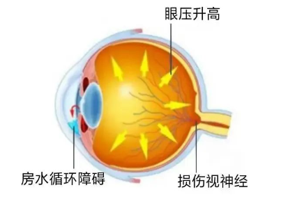 【合肥愛爾】青光眼嚴重嗎？它可能會致盲！