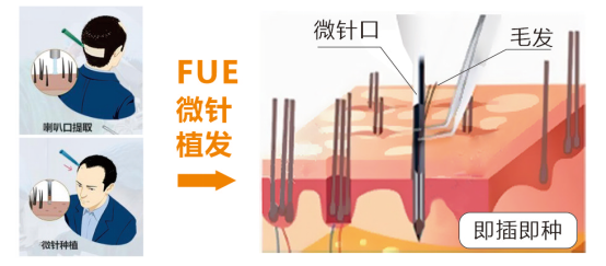 杭市一祝飛醫(yī)生植發(fā):實(shí)現(xiàn)科技創(chuàng)新性升級(jí),賦能高品質(zhì)植發(fā)體驗(yàn)