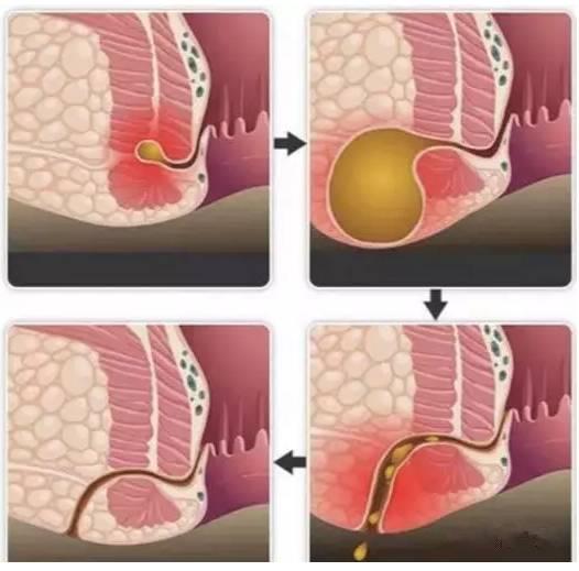 保定東大肛腸醫(yī)院看肛腸疾病怎么樣？這種高發(fā)的肛門疾病發(fā)病率僅次于痔瘡，卻幾乎無法自愈！!!!!!