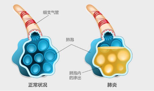 流感疫苗可以預(yù)防肺炎嗎 ？支原體肺炎更易侵襲小學(xué)生嗎？