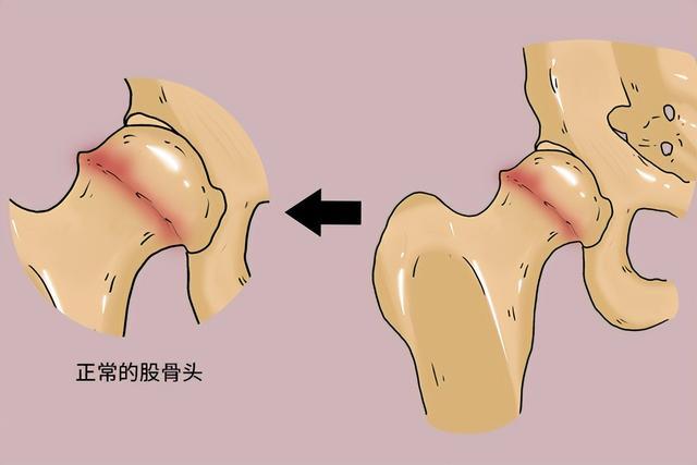 股骨頭壞死平常怎么養(yǎng)？專家推薦天然中成藥