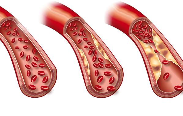高血脂的癥狀有哪些 ？高血脂會引起高血壓嗎？