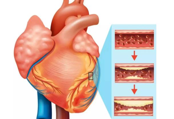 冠心病是心臟病嗎？冠心病是傳染病嗎？