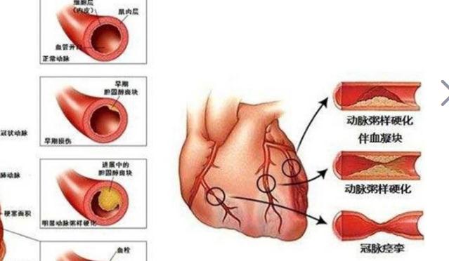 冠心病吃什么好？治療冠心病要多少錢？