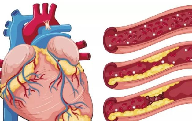 冠心病預(yù)防與保健 ？冠心病的分類？
