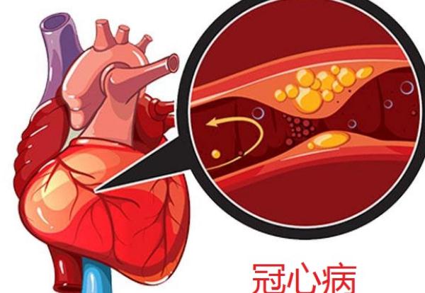 冠心病會引起頭暈嗎？冠心病會引起腳腫嗎？