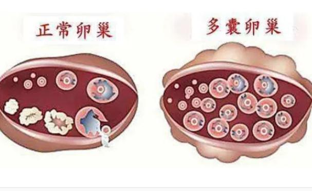 樣預(yù)防多囊卵巢？多囊為什么肚子大？