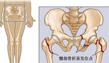 這些股骨頭壞死信號不容忽視，早期股骨頭壞死的保守治療