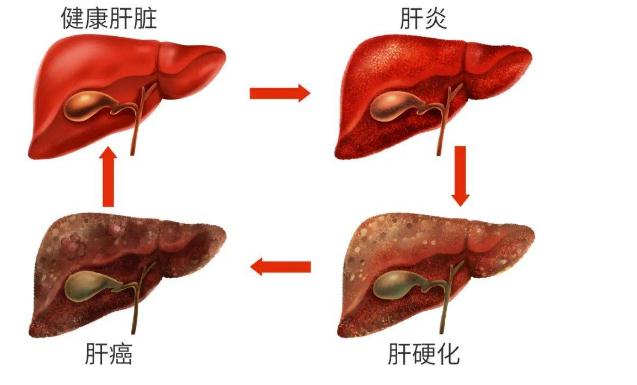 丁型肝炎有什么危害呢？丁型肝炎的癥狀有什么呢？