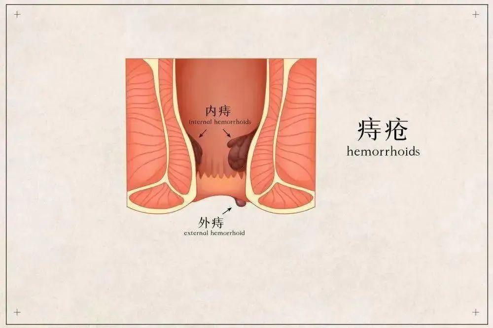 大同肛泰肛腸醫(yī)院詳解痔瘡不痛不癢不用管?這5種痔瘡真的留不得!